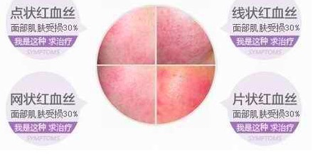 淡化紅血絲的小竅門，實用方法與日常護理建議，淡化紅血絲的小妙招，實用方法與日常護理建議