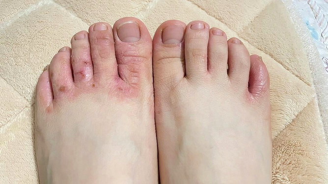 腳氣爛腳趾縫癢潰爛的治療方法，全面解析與應(yīng)對(duì)策略，腳氣爛腳趾縫癢潰爛全面解析與治療策略