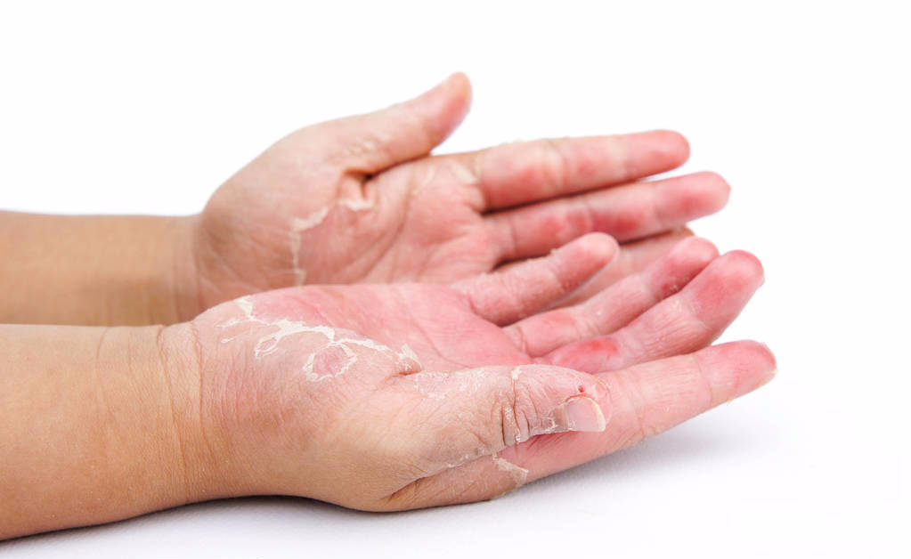 皰疹最佳治療方法，全面解析與個(gè)性化護(hù)理策略，皰疹最佳治療方法詳解，全面解析與個(gè)性化護(hù)理策略