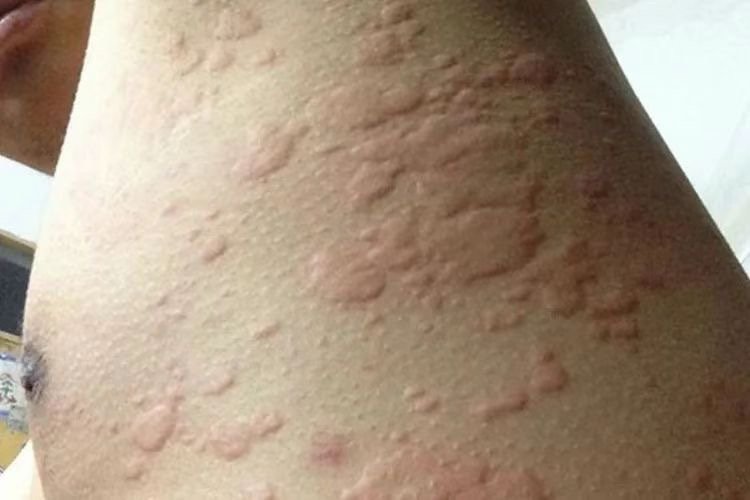 蕁麻疹最怕一個(gè)克星——揭示蕁麻疹的天然敵人，蕁麻疹的天然克星，揭示其真正的敵人